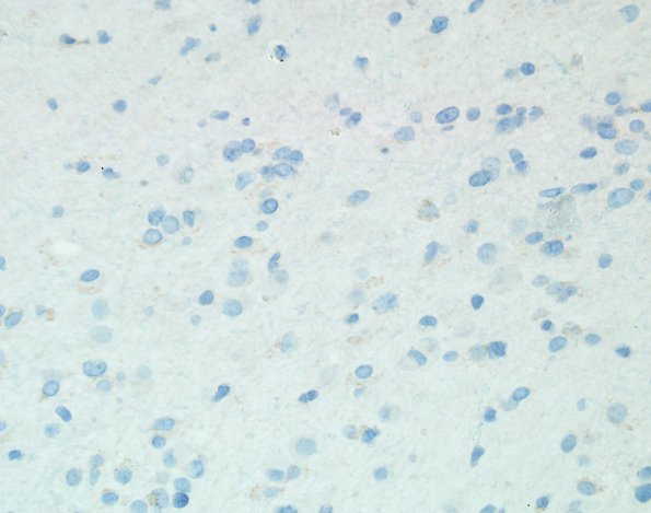 5G Ganglioglioma-gangliocytoma (Case 5) IDH1 1.jpg