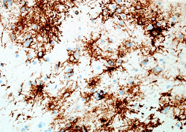 5H2 Ganglioglioma (Case 5) CD34 4.jpg