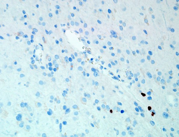 5I Ganglioglioma-gangliocytoma (Case 5) Ki67 2.jpg