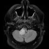 6A1 Ganglioglioma (Case 6) FLAIR 1 - Copy