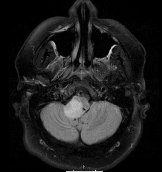 6A1 Ganglioglioma (Case 6) FLAIR 1 - Copy