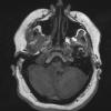 6A2 Ganglioglioma (Case 6) T1 NoC 1 - Copy