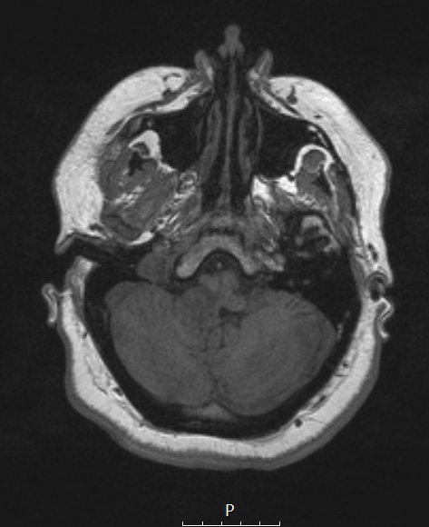 6A2 Ganglioglioma (Case 6) T1 NoC 1 - Copy