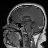 6A3 Ganglioglioma (Case 6) T1W Sagittal 1 - Copy