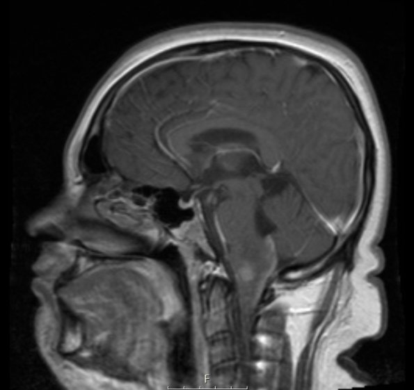 6A3 Ganglioglioma (Case 6) T1W Sagittal 1 - Copy