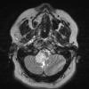 6A4 Ganglioglioma (Case 6) T2 W 1 - Copy