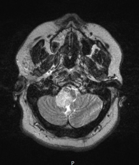 6A4 Ganglioglioma (Case 6) T2 W 1 - Copy