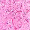 6B1 Ganglioglioma (Case 6) H&E 3 (2) copy