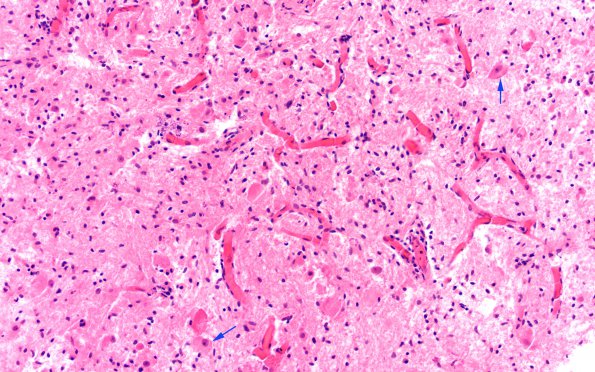 6B1 Ganglioglioma (Case 6) H&E 3 (2) copy