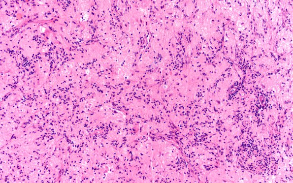 6B2 Ganglioglioma (Case 6) H&E 2