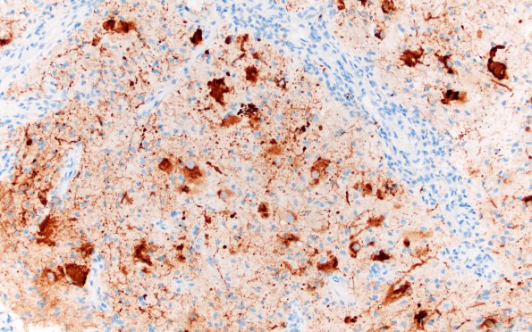 6D Ganglioglioma (Case 6) Chromogranin 2