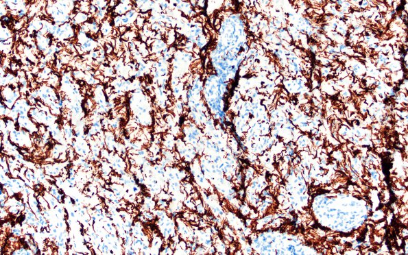 6F Ganglioglioma (Case 6) GFAP