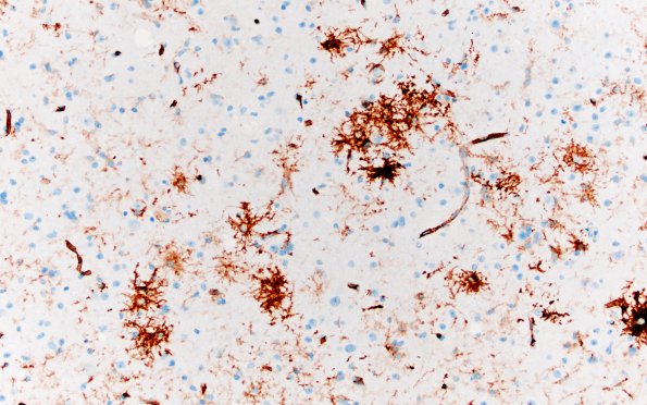 6H Ganglioglioma (Case 6) CD34 3