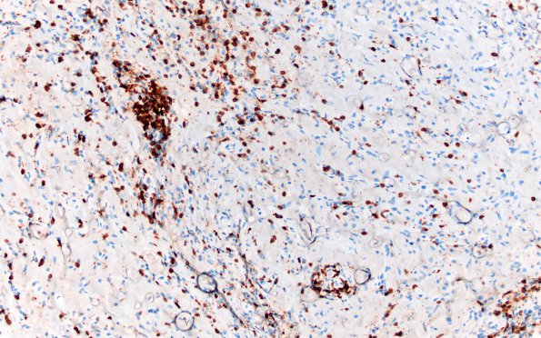 6I Ganglioglioma (Case 6) CD3