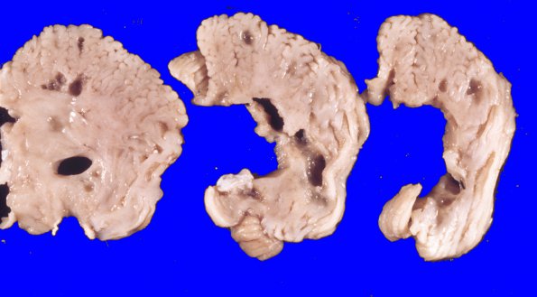 7A Ganglioglioma (Case 7)