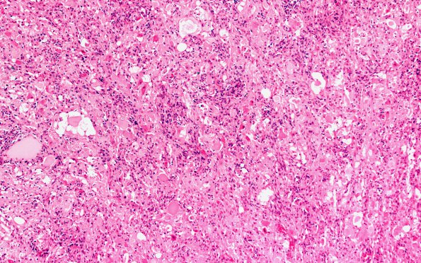 7B1 Ganglioglioma (Case 7) H&E 10X