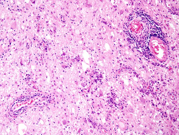 7B2 Ganglioglioma (Case 7)  H&E 2