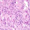 7B3 Ganglioglioma (Case 7)  H&E 5