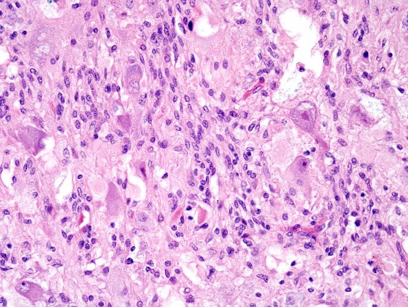 7B3 Ganglioglioma (Case 7)  H&E 5