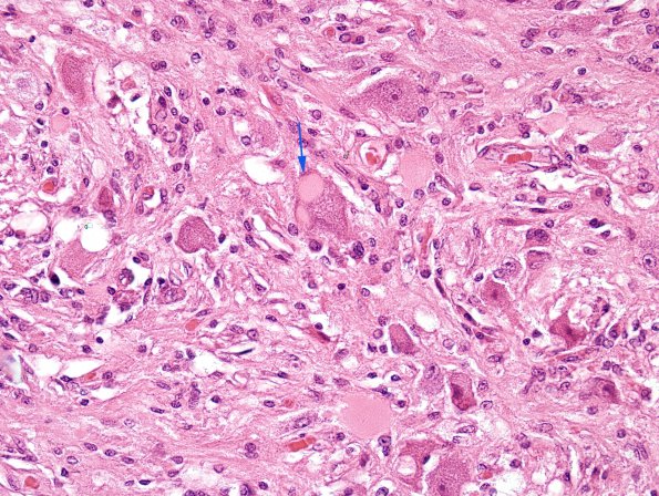 7B4 Ganglioglioma (Case 7) H&E 2 copy