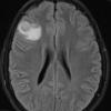 8A1 Ganglioglioma (Case 8) FLAIR 1 - Copy