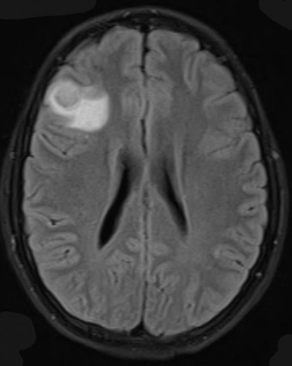 8A1 Ganglioglioma (Case 8) FLAIR 1 - Copy