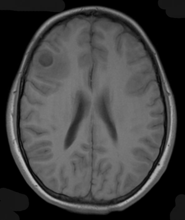 8A2 Ganglioglioma (Case 8) T1 2 - Copy