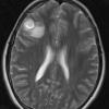 8A3 Ganglioglioma (Case 8) T2 - Copy