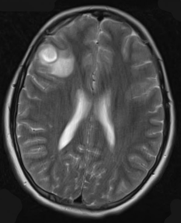 8A3 Ganglioglioma (Case 8) T2 - Copy