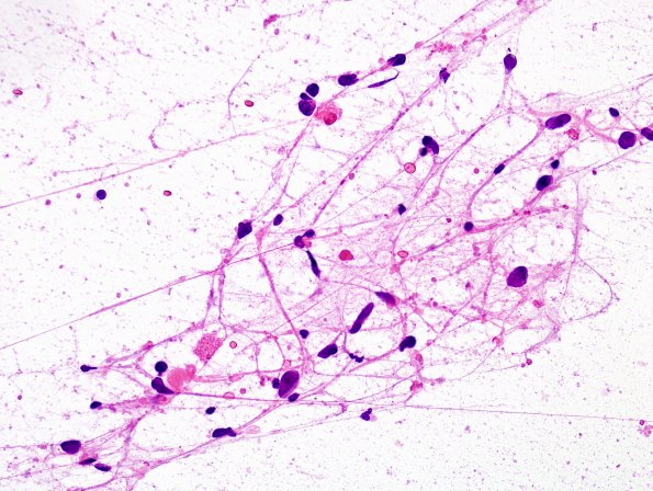 8B1 Ganglioglioma (Case 8) H&E smear 3