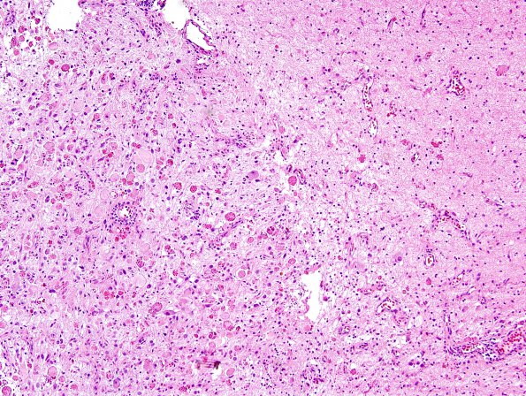 8B2 Ganglioglioma (Case 8) H&E 2