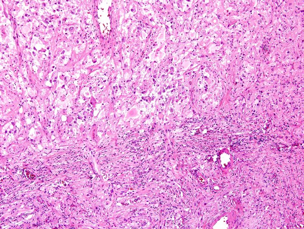 8B4 Ganglioglioma (Case 8) H&E 7