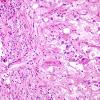 8B5 Ganglioglioma (Case 8) H&E 8