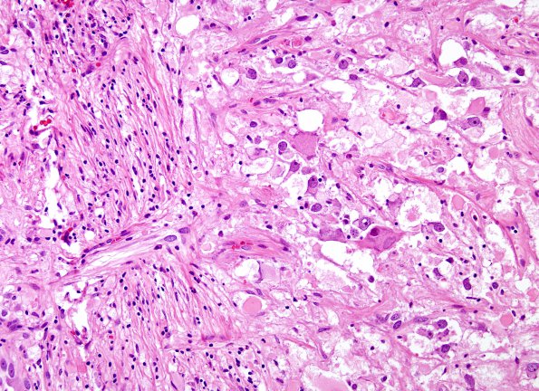 8B5 Ganglioglioma (Case 8) H&E 8