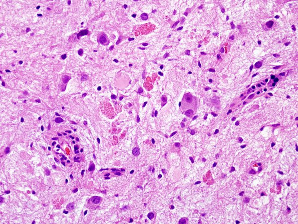 8B6 Ganglioglioma (Case 8) H&E 17