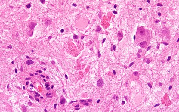 8B7 Ganglioglioma (Case 8) H&E 60X