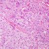 8B8 Ganglioglioma (Case 8) H&E 5