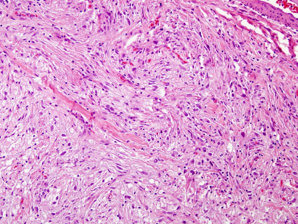 8B8 Ganglioglioma (Case 8) H&E 5