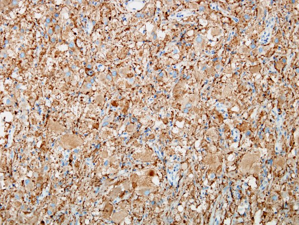 8C1 Ganglioglioma (Case 8) SYN 11