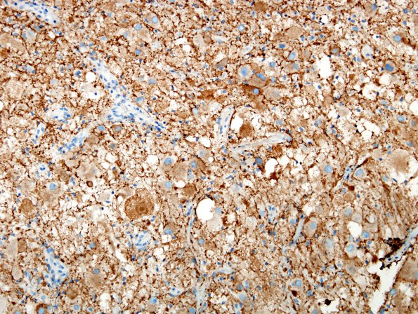 8C2 Ganglioglioma (Case 8) SYN 9