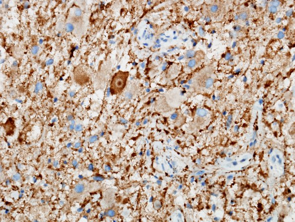 8C3 Ganglioglioma (Case 8) SYN 6