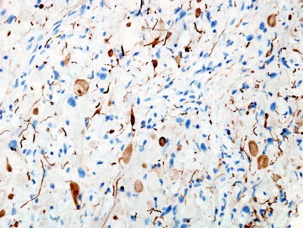 8D1 Ganglioglioma (Case 8) NFil 1