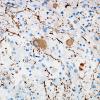 8D2 Ganglioglioma (Case 8) NFil 10