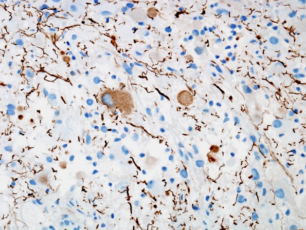 8D2 Ganglioglioma (Case 8) NFil 10