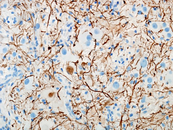 8D2 Ganglioglioma (Case 8) NFil 4