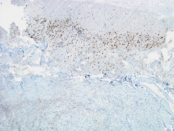 8E1 Ganglioglioma (Case 8) NeuN 19