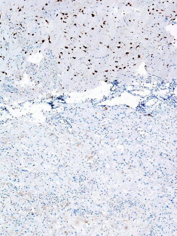 8E2 Ganglioglioma (Case 8) NeuN 2