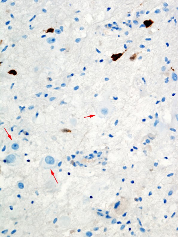 8E3 Ganglioglioma (Case 8) NeuN 10 copy