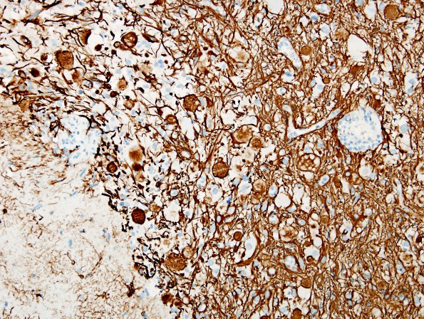 8F1 Ganglioglioma (Case 8) GFAP 10