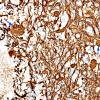 8F2 Ganglioglioma (Case 8) GFAP 1 copy